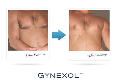 Gynexol User Review'