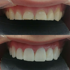 Dental Implants In Mexico'