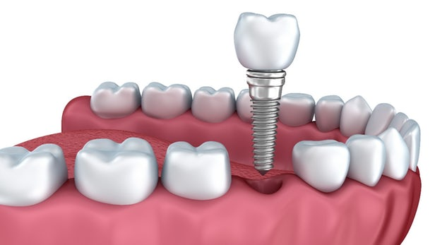Dental Implants Market