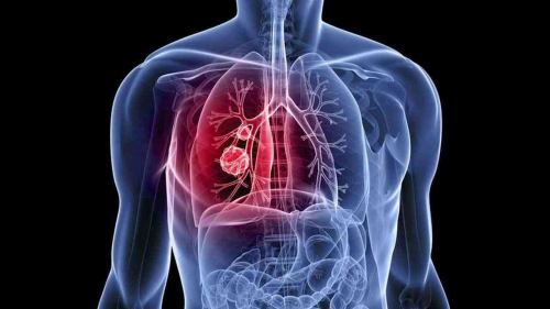 Non-small Cell Lung Cancer Therapeutics Market'