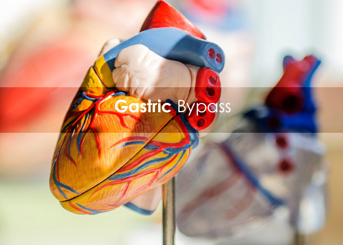Gastric Bypass Queens New York'