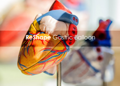 ReShape Gastric Ballon Procedure - Queens Weight LossSurgery'