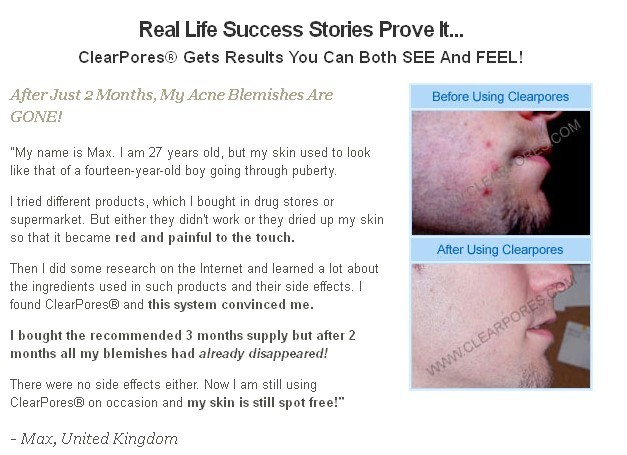 Proper Acne Treatment'