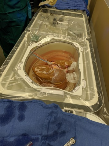 Intermountain Healthcare liver pump