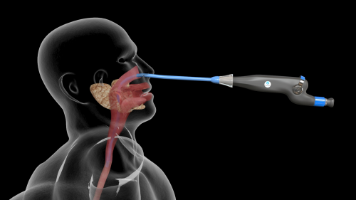 Esophageal Introducer with Endoscope'