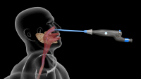 Esophageal Introducer with Endoscope