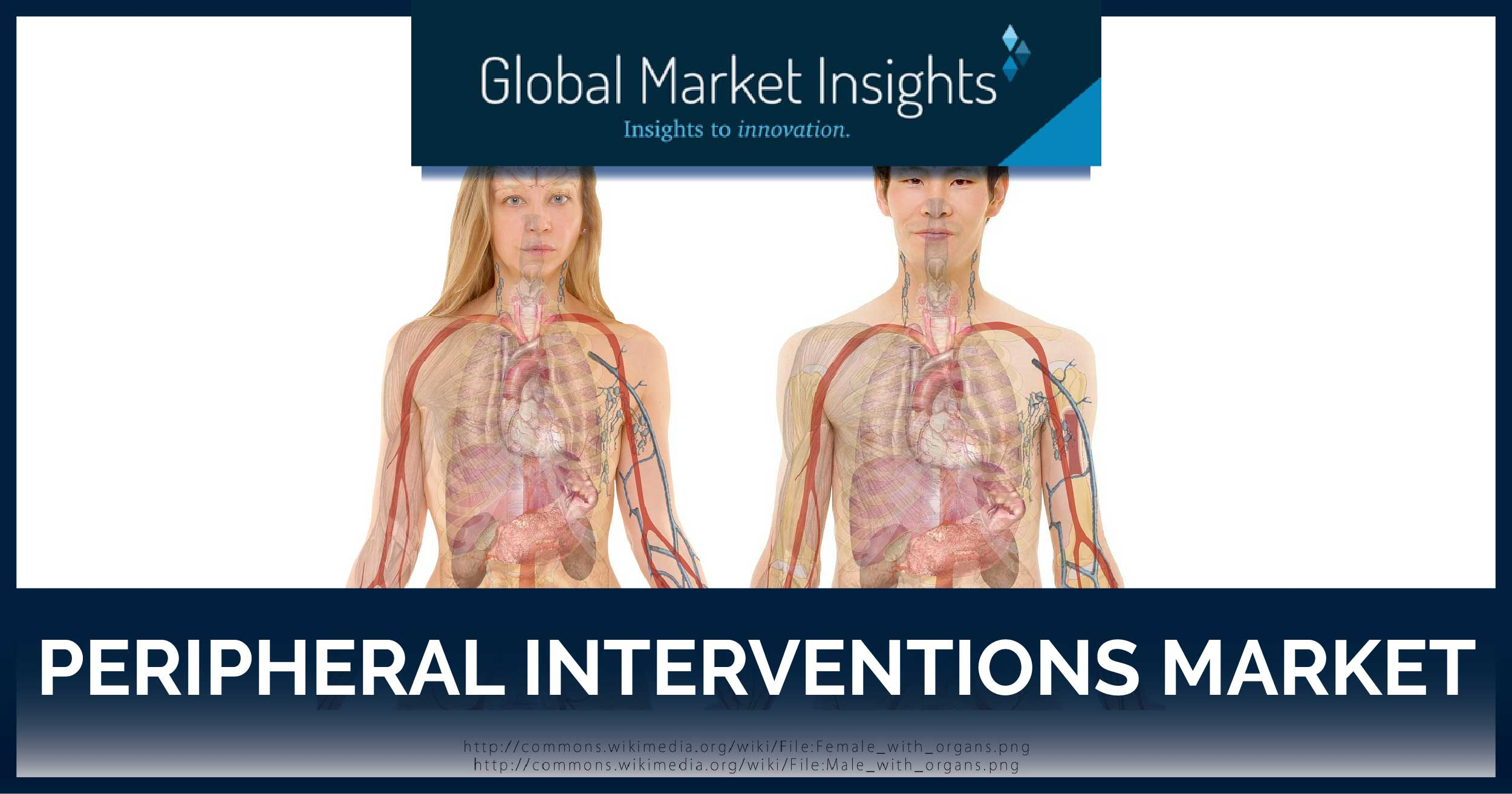 Peripheral Interventions Market'