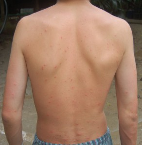 How To Get Rid Of Back Acne'