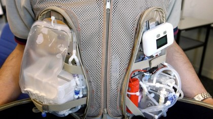 Artificial Kidney Market