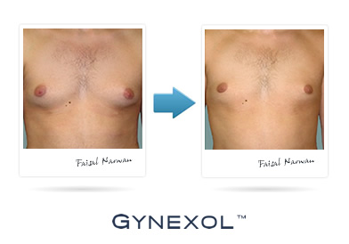 Gynexol Pics'