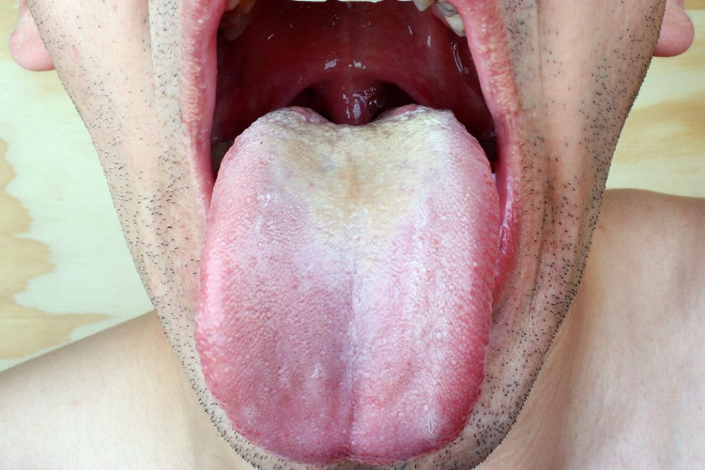 Oral Thrush'