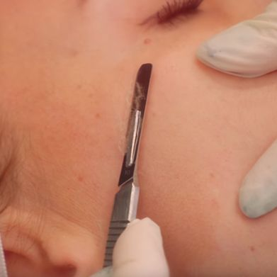 Laser Hair Removal'