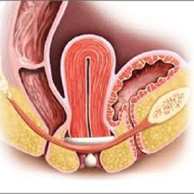 Vaginal Pessary'