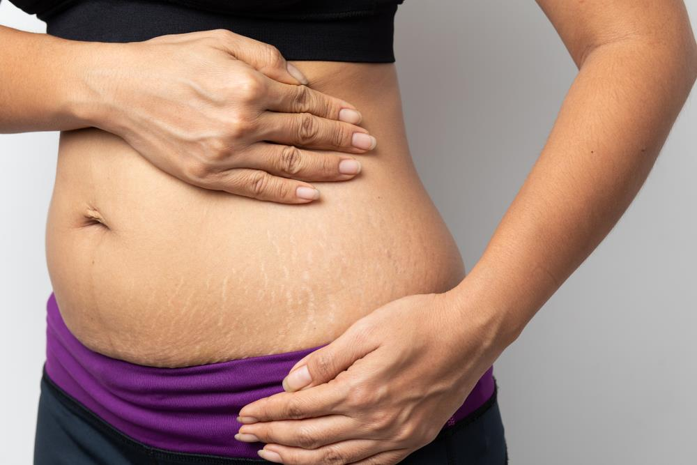 Company Logo For Stretch Marks On Belly'