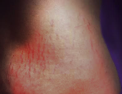 Revitol Stretchmark Cream X-tra