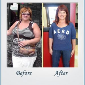 Weight Loss Surgery In Mexico'