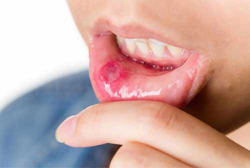 Mouth Ulcers Drugs'