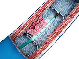 Thrombolysis'