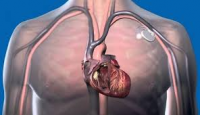 Pacemaker Devices Market