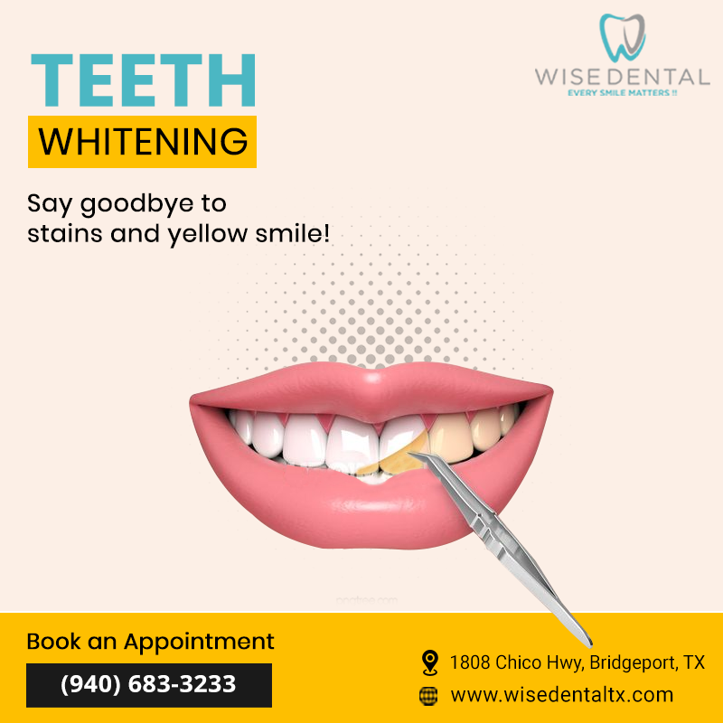 Teeth Whitening Treatment'