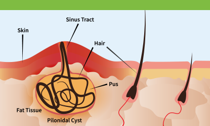 Antibiotic Management for Pilonidal Disease'