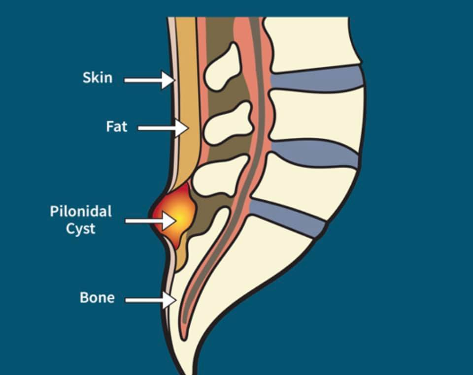 Emergency Surgical Drainage'