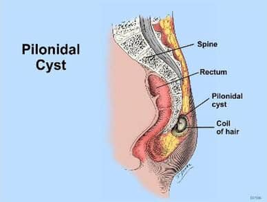 Pilonidal Surgical Removal'