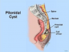 Pilonidal Surgical Removal'