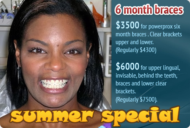 6 Month Braces from Raleigh Orthodontist