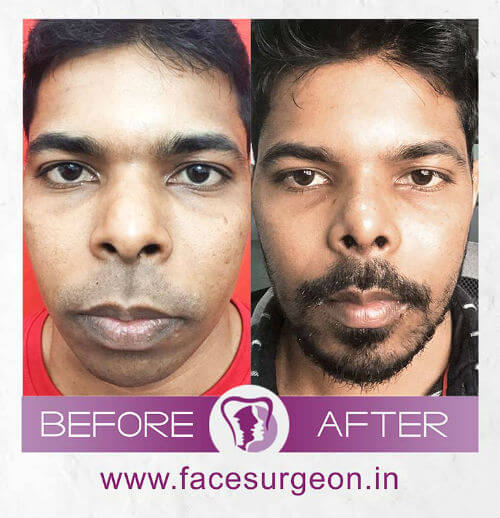 Nose Surgery in India'