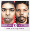 Nose Surgery in India'