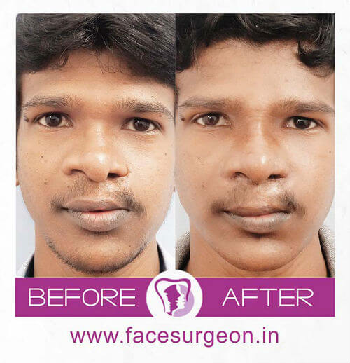 Cleft Rhinoplasty Surgery in India'