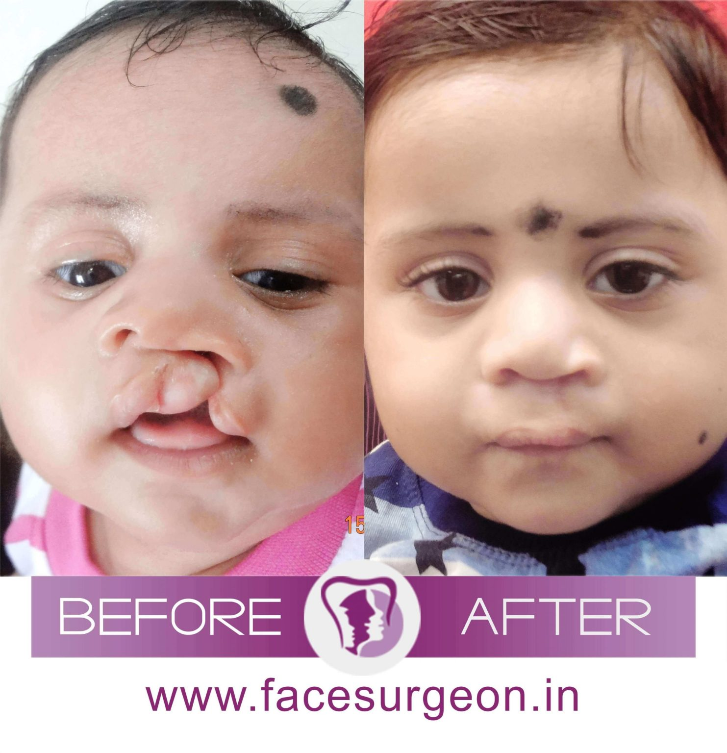Cleft Lip Surgery Treatment'