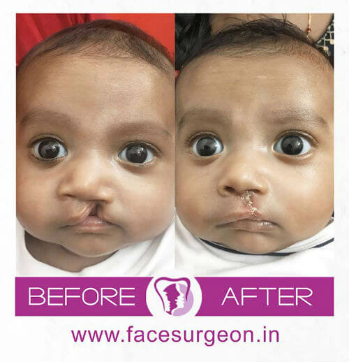 Cleft Lip Surgery for Baby in India'