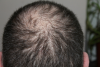 Tackle Hair Loss With PRP'