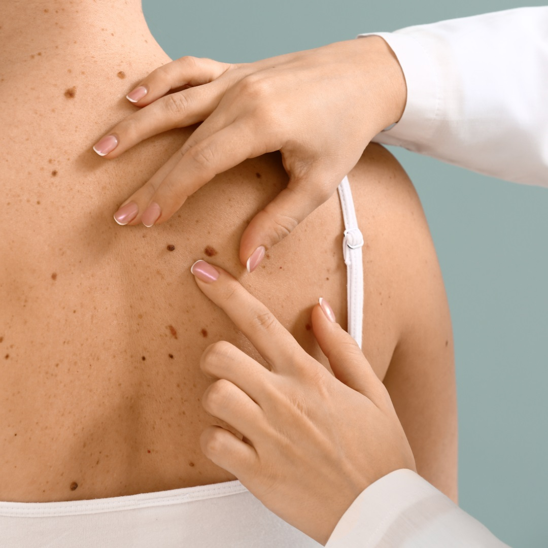 Skin Tag Removal Irvine'