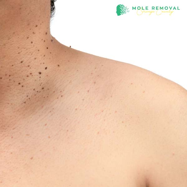 Irvine Skin Tag Removal'