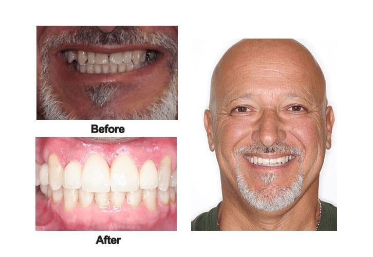 Dental Implants'