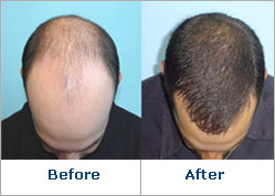 Provillus Result'