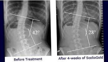 Scoliosis Support Ireland'
