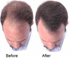Regrow Hair'