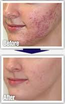 Acne Treatment'
