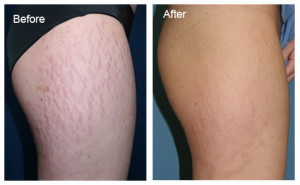 Stretch Mark Cream Before After'