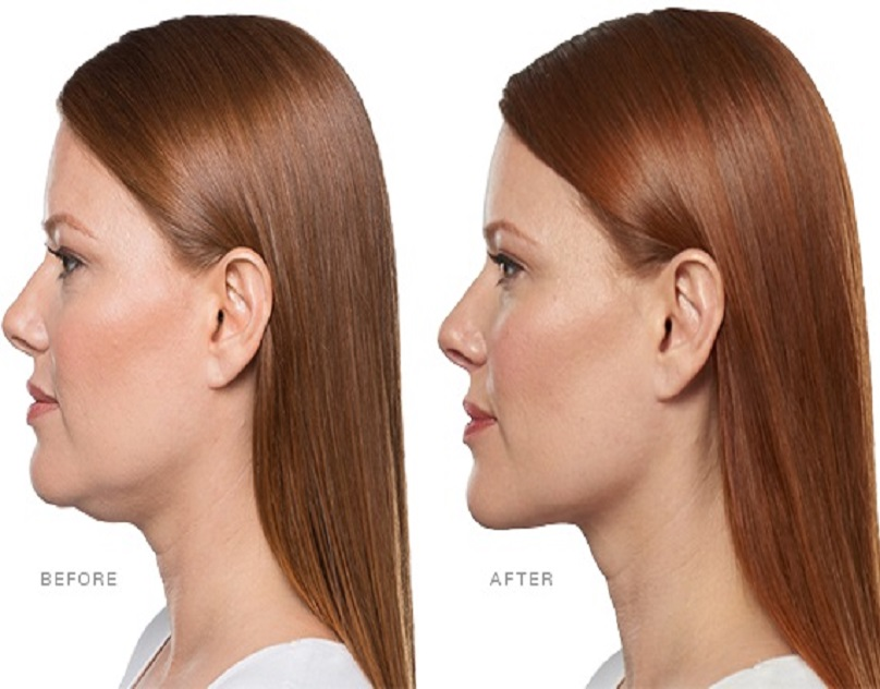 Hydra-Facials'