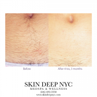 Top Rated MedSpa NYC - Skin Deep NYC Best Hair Removal
