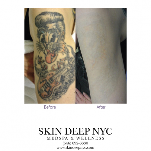 Top Rated MedSpa NYC - Skin Deep NYC Best Tattoo Removal'