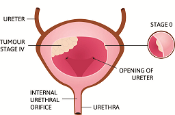 TURP Procedure Brooklyn'