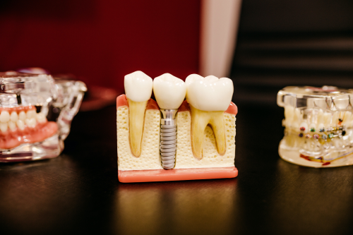 Will Medicare Cover Dental Implants?'