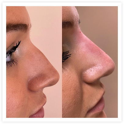 Hydrafacial'
