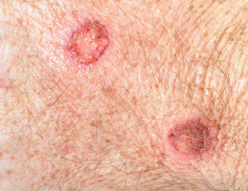 Healing Warts
